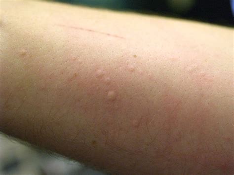 See If Stress Can Cause Hives