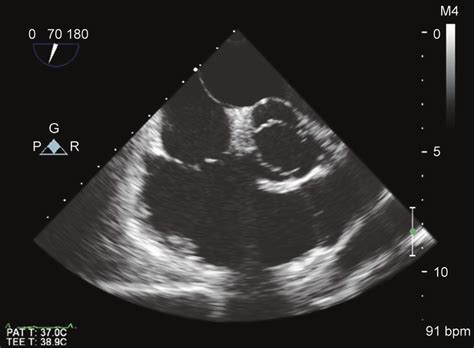 Preoperative Right Ventricular Inflow Outflow View Showing Normal Right