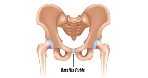 Osteitis Pubis Symptoms Causes Treatment And Rehabilitation