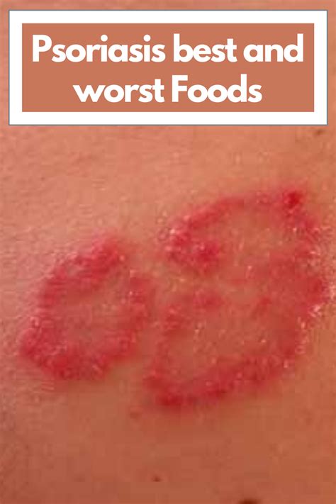 Psoriasis Worst And Best Foods Psoriasis Psoriasis Recipes Foods To