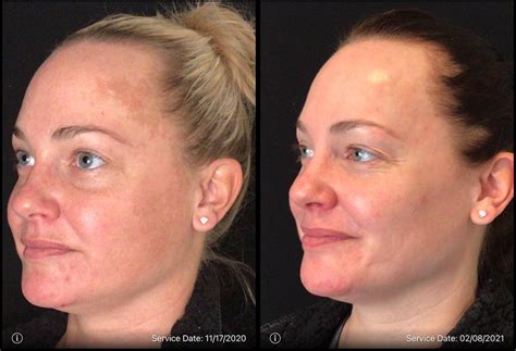 Fractional Laser Before And After Photos In Washington Dc Younger