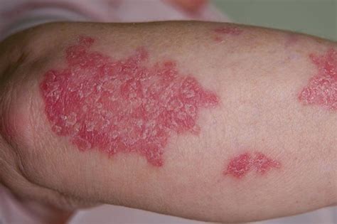 Psoriasis Symptoms And Diagnosis Hseie