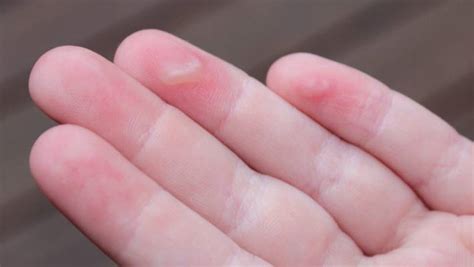 Child Burns Fingers On Hot Slide At Margaret Mahy Playground Nz