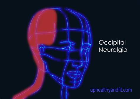 Occipital Neuralgia Trigger Points