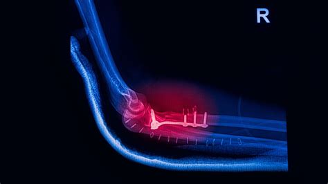7 Easy Elbow Fracture Rehabilitation Exercises Physiosunit