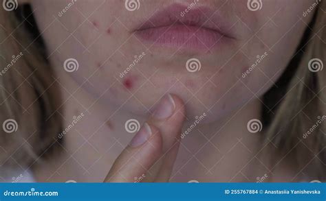 Unrecognizable Woman Showing Her Acne On Face Close Up Acne On Woman S