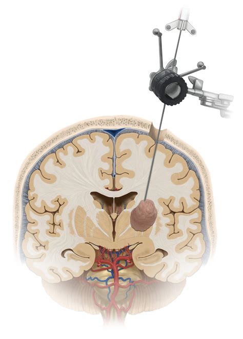 Stereotactic Brain Biopsy Expert Surgeon Aaron Cohen Gadol Md