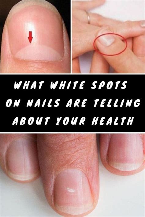 The Best What Do White Lines On Fingernails Indicate References Inya Head
