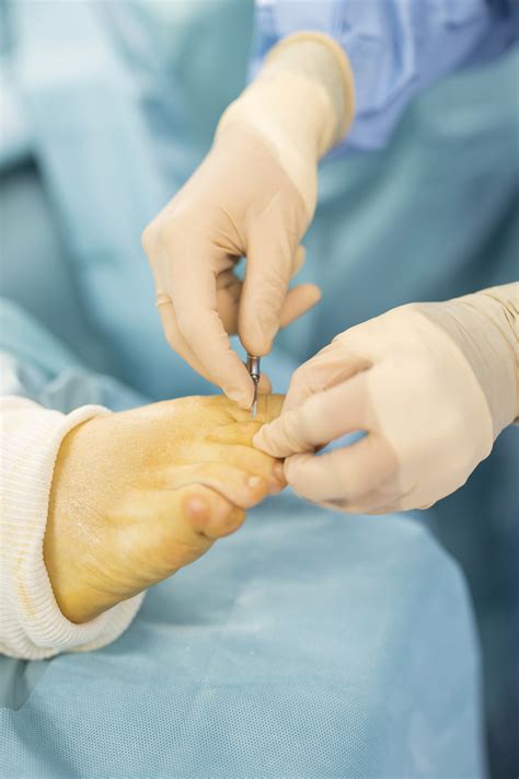 Chirurgie percutanée Centre du pied