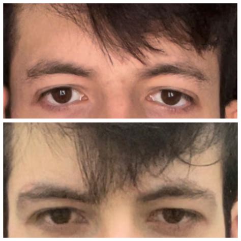 EYE AREA MAXXING RESULTS POST YOUR BEFORE AND AFTER HERE Looksmax