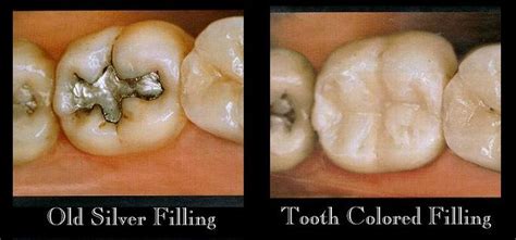 White Fillings North Vancouver Valley Centre Dental Group