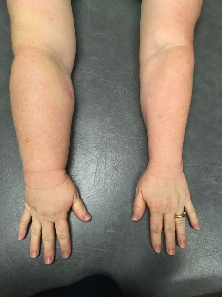 Risk Of Lymphedema Following Cancer Interventions Encore Rehabilitation