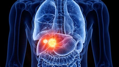 Maybe you would like to learn more about one of these? Scientists found four potential liver cancer-killing ...