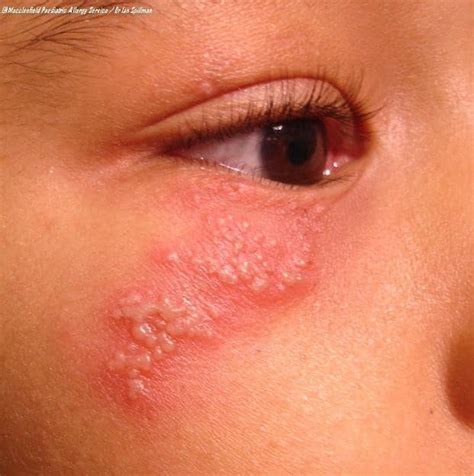 Eczema Atopic Dermatitis North West Allergy Network