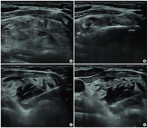 1 Cm Thyroid Nodule