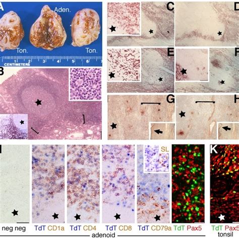 Phenotype Of Tdt Cells In Adenoids Tonsils And Secondary Lymphoid