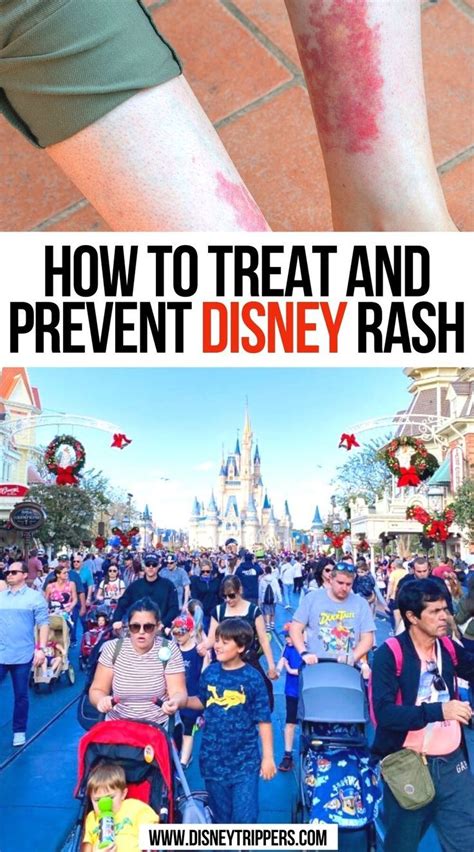 How To Treat And Prevent Disney Rash Disney World Tips And Tricks