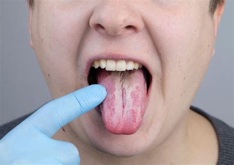 Grzybica Jamy Ustnej Przyczyny Objawy I Leczenie