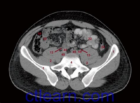 Axial Ct Scans Of The Abdomen And Pelvis Ct Scans Of The Abdomen My
