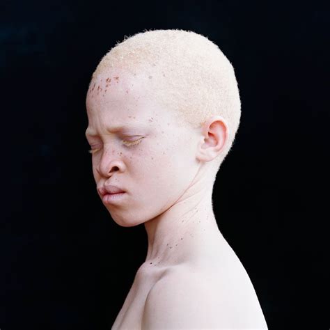 Abdel Sarune Mac We Are The World People Of The World Albino African Modelo Albino Melanism