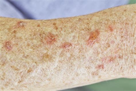 Successful Treatment Of Solar Keratosis With Home Remedies
