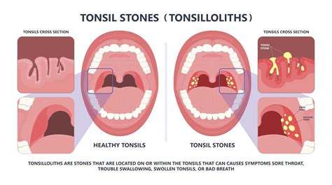 Bad Breath You May Have Tonsil Stones