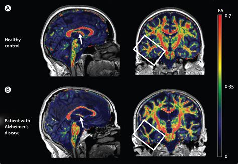 Multimodal Imaging In Alzheimers Disease Validity And Usefulness For