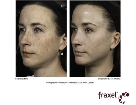 Before And After Fraxel For Pigmentation Age Spot Removal Spots On