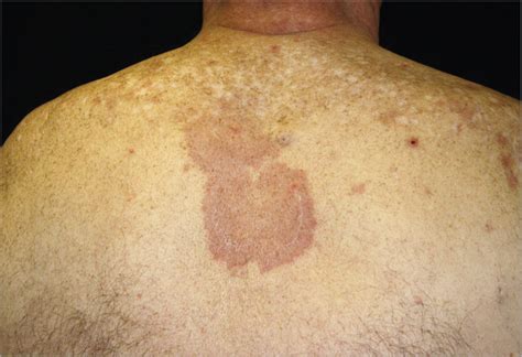 Interstitial Granulomatous Dermatitis As The Initial Manifestation Of