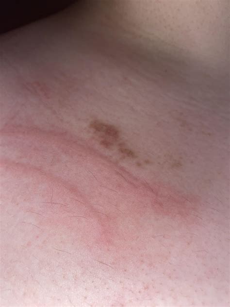 Does Anyone Know What This Scaly Skin Near My Neck Is The Red Lines