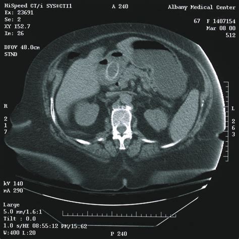Bouverets Syndrome Complicated By Distal Gallstone Ileus After Laser