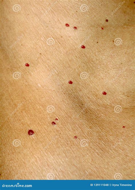 Angioma On The Skin Red Moles On The Body Many Birthmarks Royalty