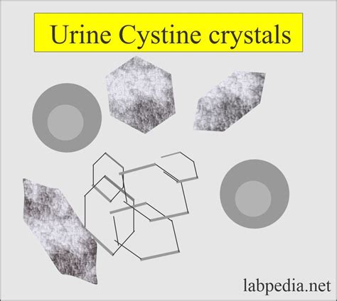 Urine Crystals Crystalluria