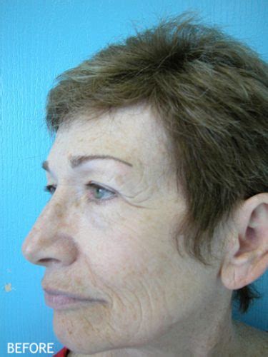 Skin Rejuvenation Patient 11 Temecula Ca Dr Kelly Oneil