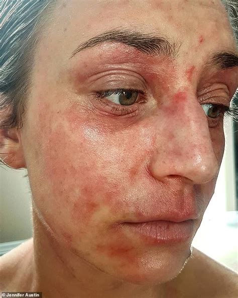 Woman 26 With Eczema Praises £8 Natural Cream Made From Cows Udders
