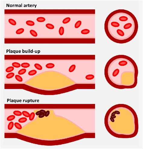 The Atherosclerotic Plaque Illustration Depicting The Progression Of