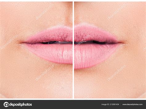 Woman Lips Lip Filler Injections Fillers Lip Augmentation Beautiful