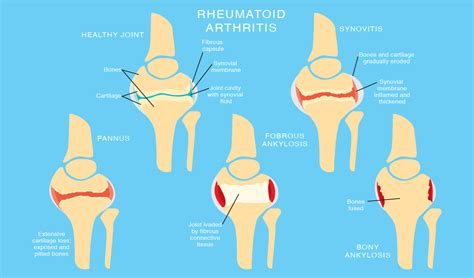 Unknownillness Foot Or Ankle Pain With Swollen Joints—rheumatoid