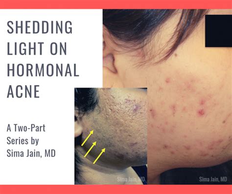Part Hormonal Acne Exam Work Up Diagnosis Next Steps In Dermatology