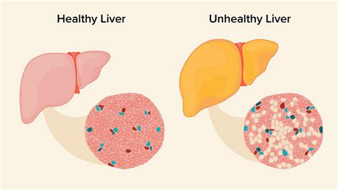 5 Signs You Need A Liver Detox Me First Living