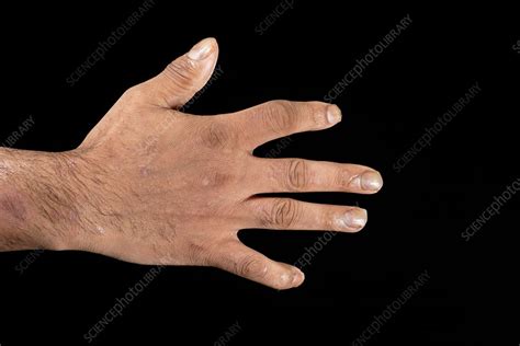 Psoriatic Arthritis Stock Image C0227092 Science Photo Library