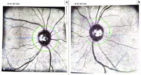 Showing The Narrowing Of The Neuroretinal Rim Of The Optic Nerve In The