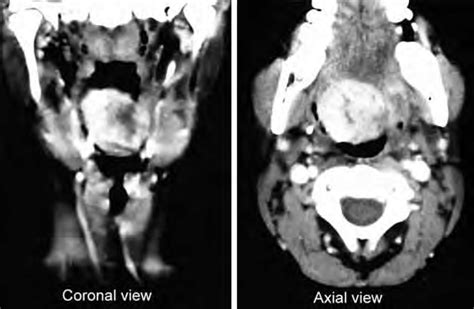 Contrast Enhanced Computed Tomography Neck Coronal And Axial Sections
