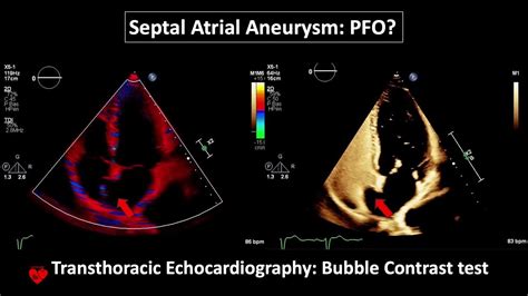 Atrial Septal Aneurysm Pfo Transthoracic Echocardiography Buble