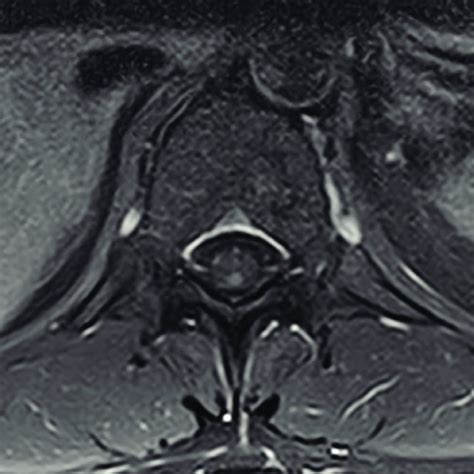 Axial T1 Weighted Mri Image Of The Lumbar Spine After Gadolinium