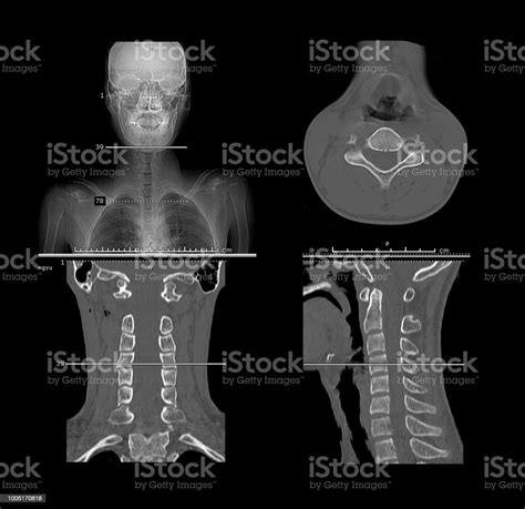 Ct Scan Image Of Cervical Spine 2d Image With Coronal Sagittal And