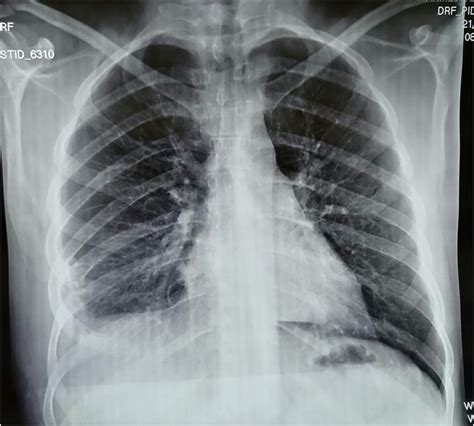 Control Chest X Ray One Month After Surgery Download Scientific Diagram