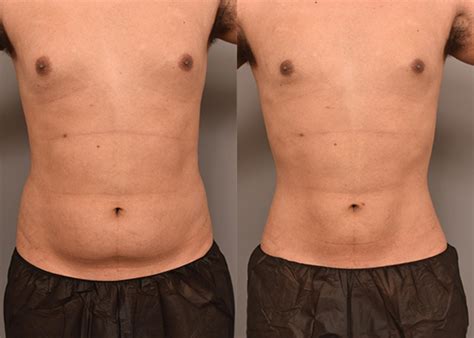 Liposuction Before And After Men