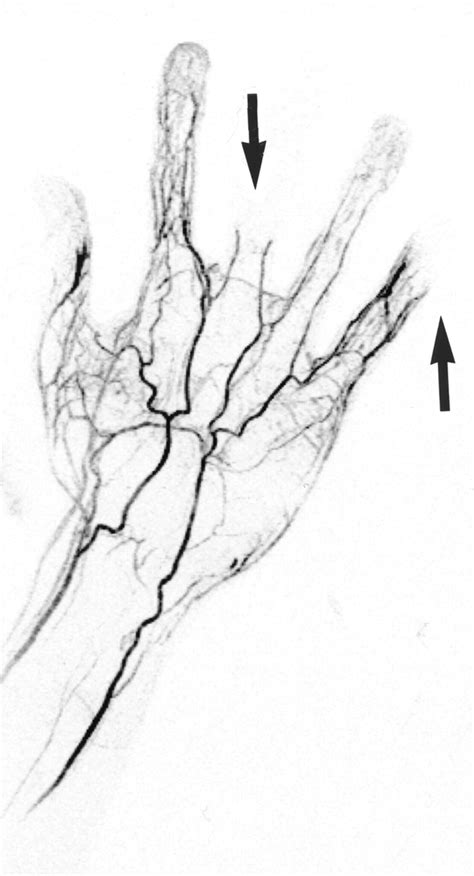 Contrast Enhanced Mr Angiography And Perfusion Imaging Of The Hand Ajr