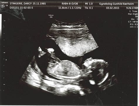 16 Week Sonogram Lopiforall